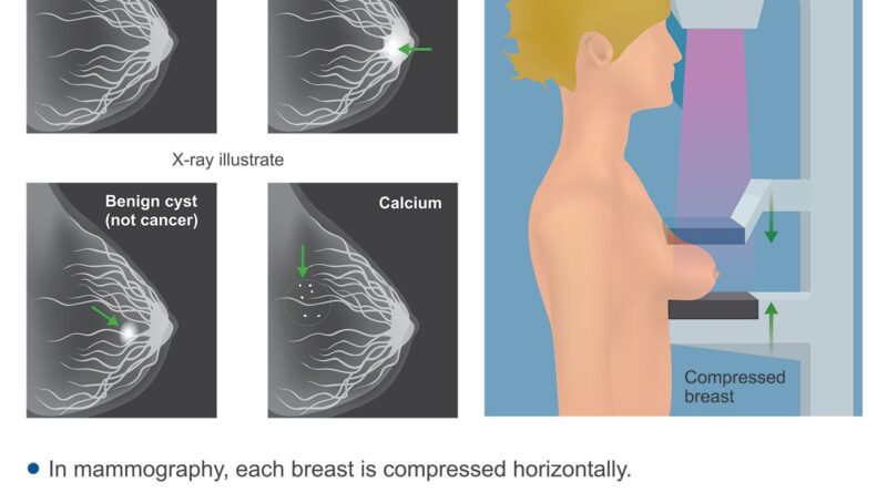How much is a mammogram without insurance and breast ultrasound cost