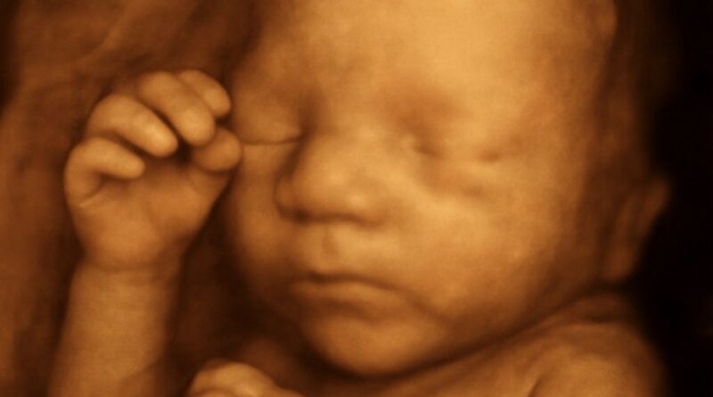 10 week ultrasound pictures and cost of brain MRI