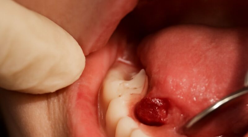 dry socket symptoms and wisdom teeth