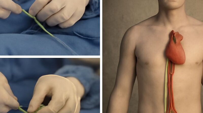 Heart ablation and cardiac ablation procedure